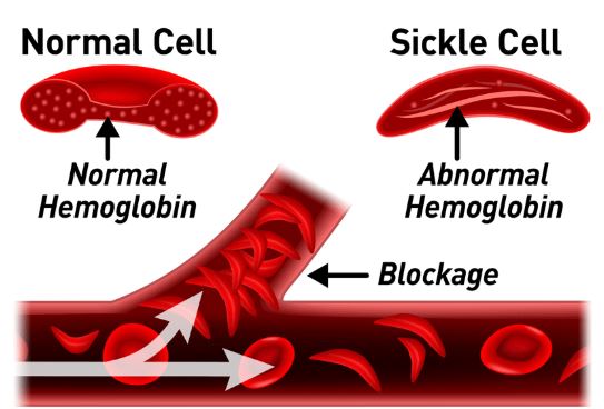 Sickle Cell