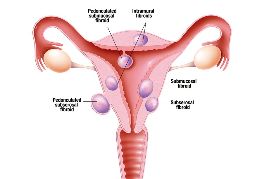 Fibroids Image